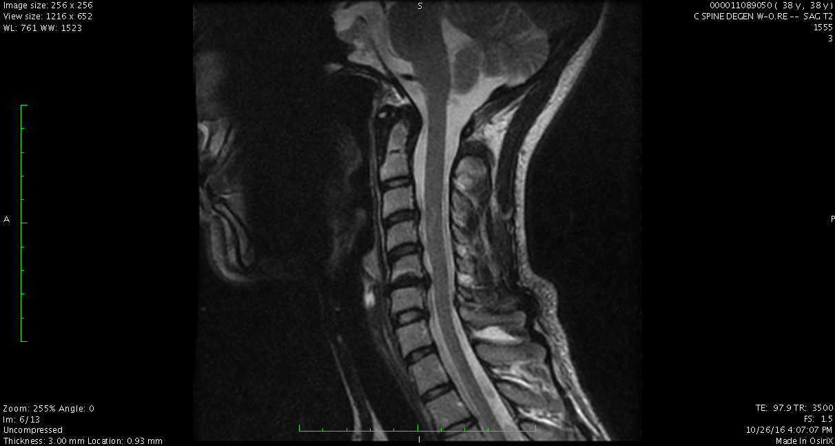 C-Spine MRI