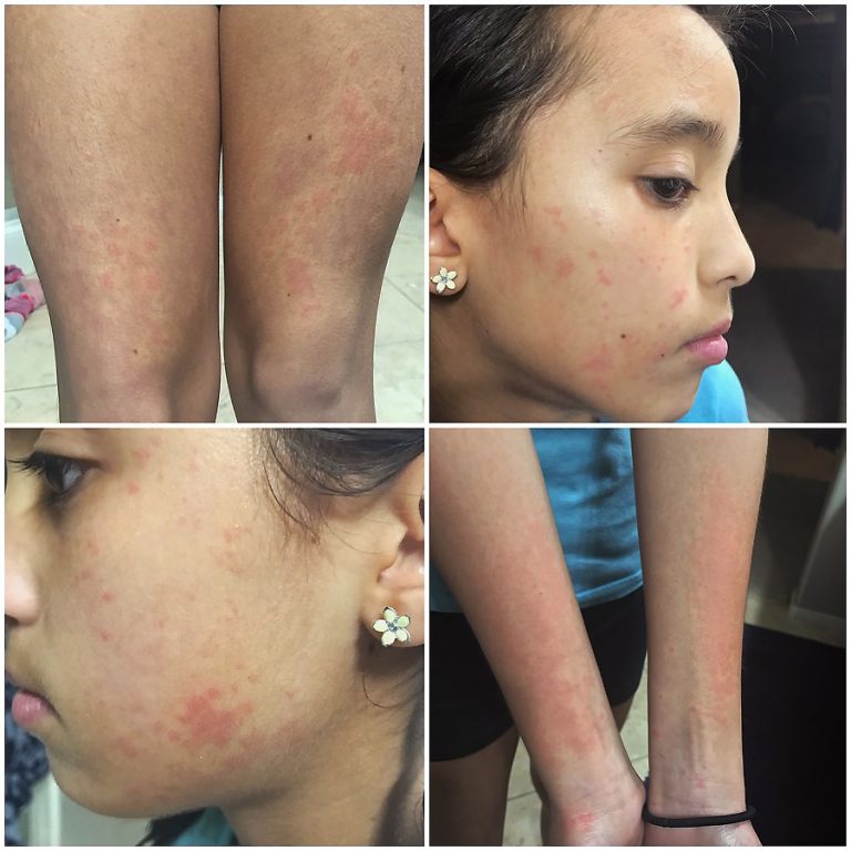 Still's Disease (aka SJIA) Nourish Empower Fulfilled